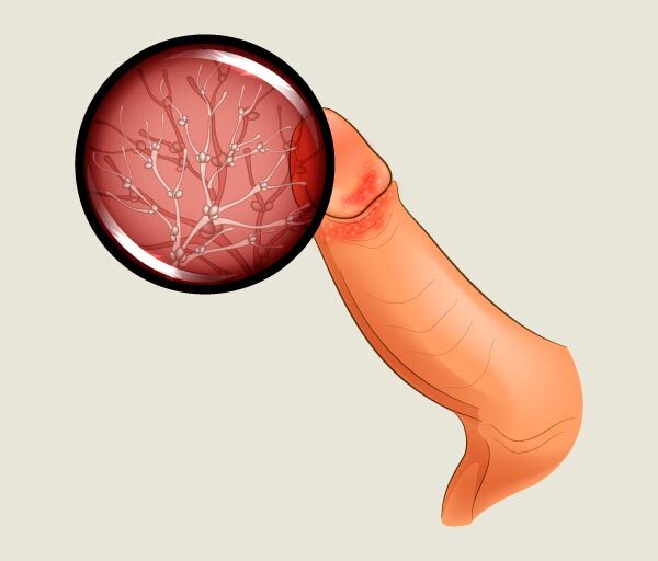 Balanitis Surgery in Karli