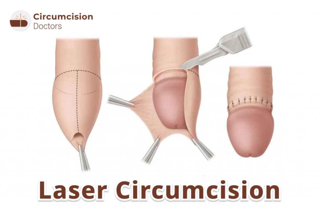 Laser Circumcision – Surgery Procedure, Recovery & Risks