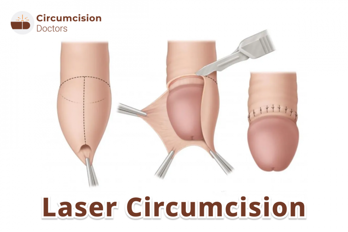 Laser Circumcision