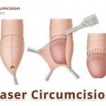 Laser Circumcision
