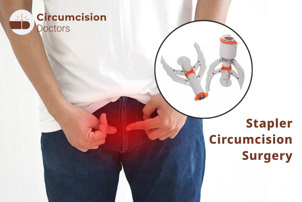 Stapler Circumcision Surgery – Procedure, Recovery & Benefits