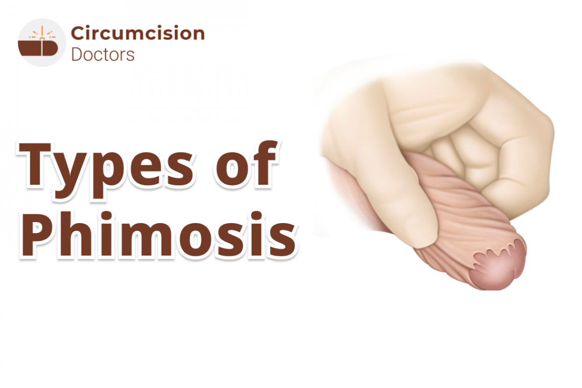 types of phimosis