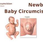Newborn Baby Circumcision