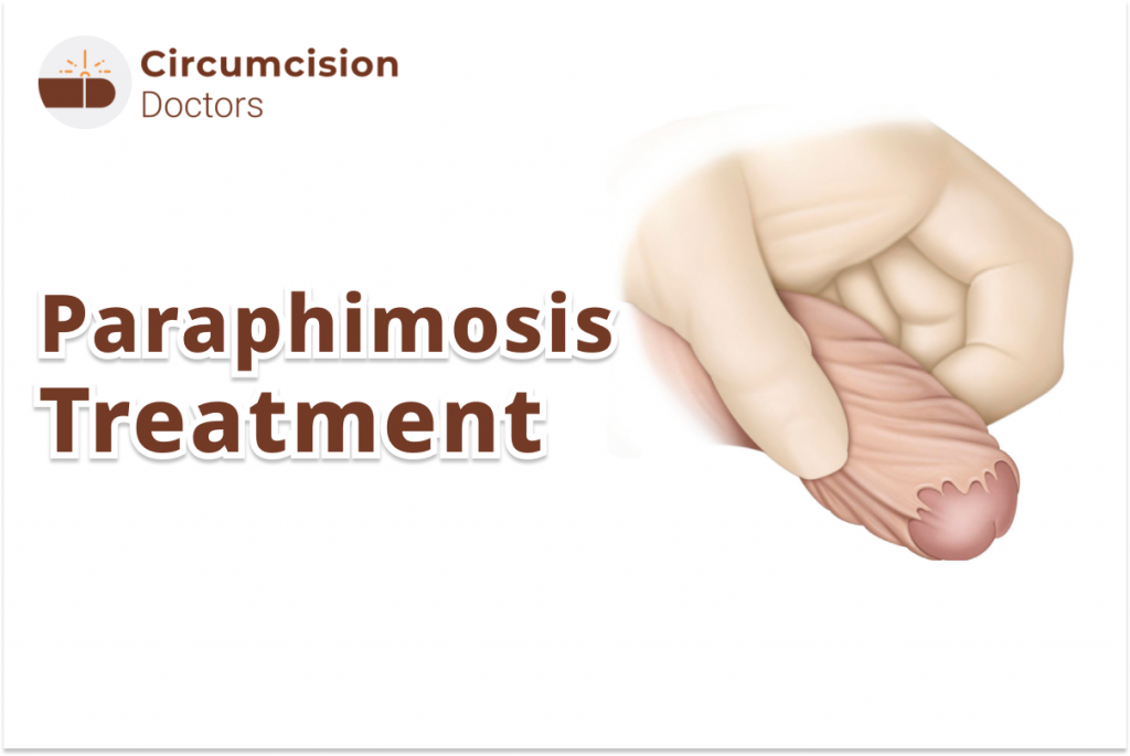 Paraphimosis Treatment – Symptoms, Causes & Surgery