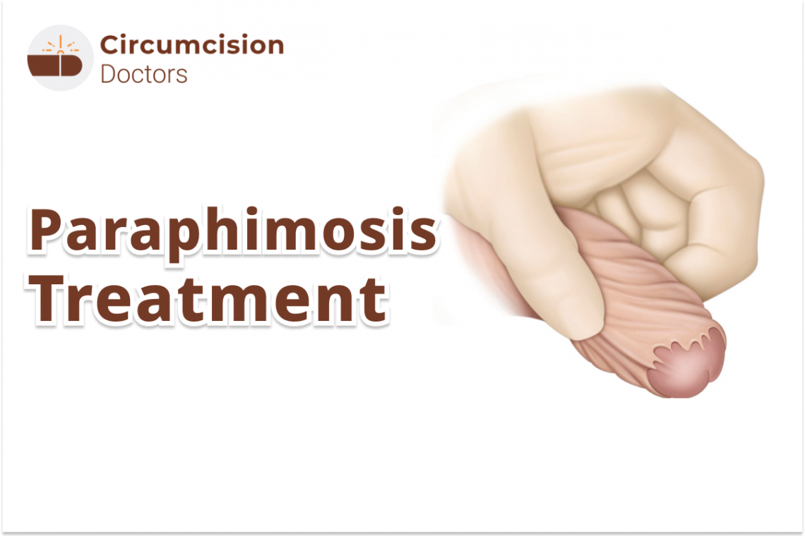 Paraphimosis Treatment